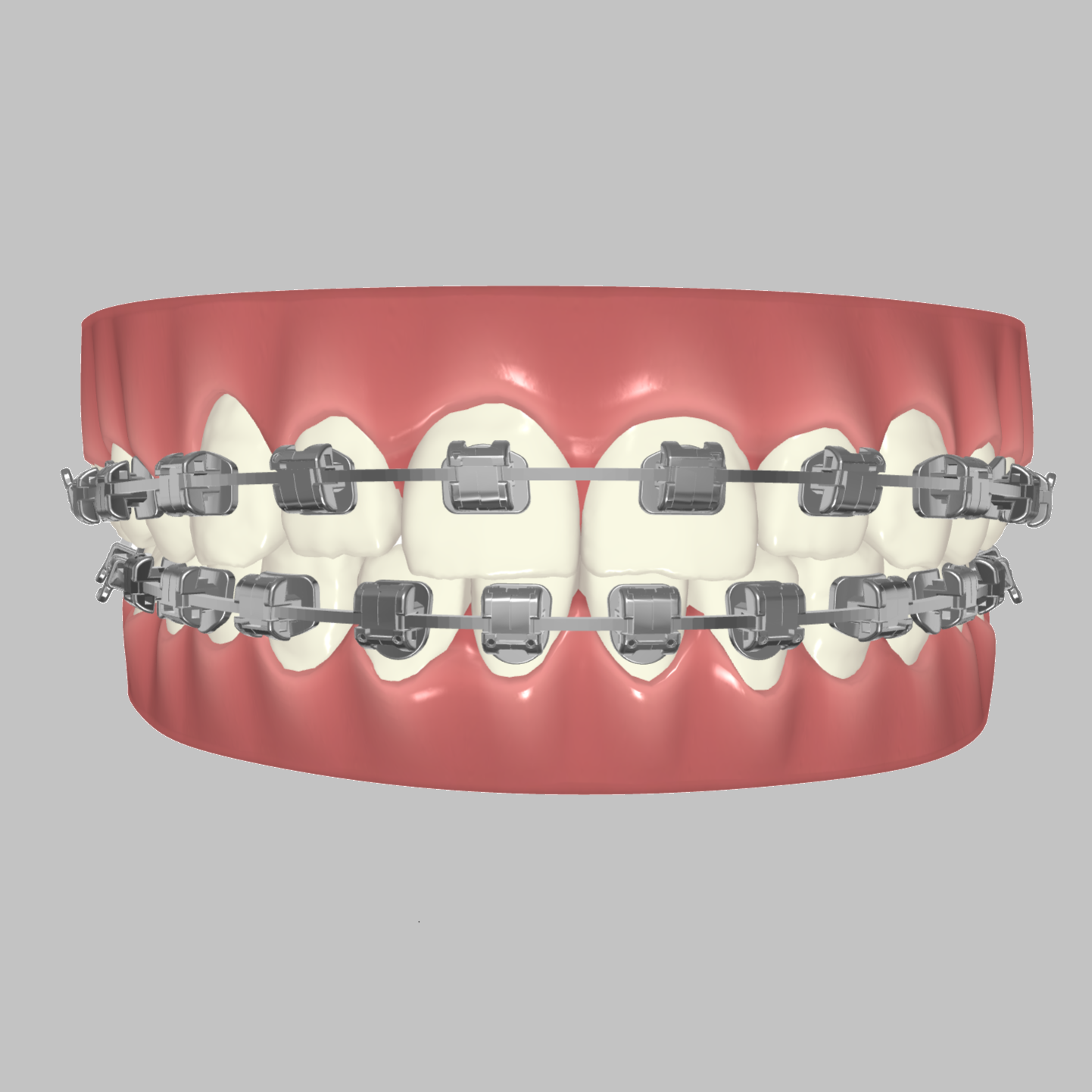 Custom Braces - as easy as clear aligners!
