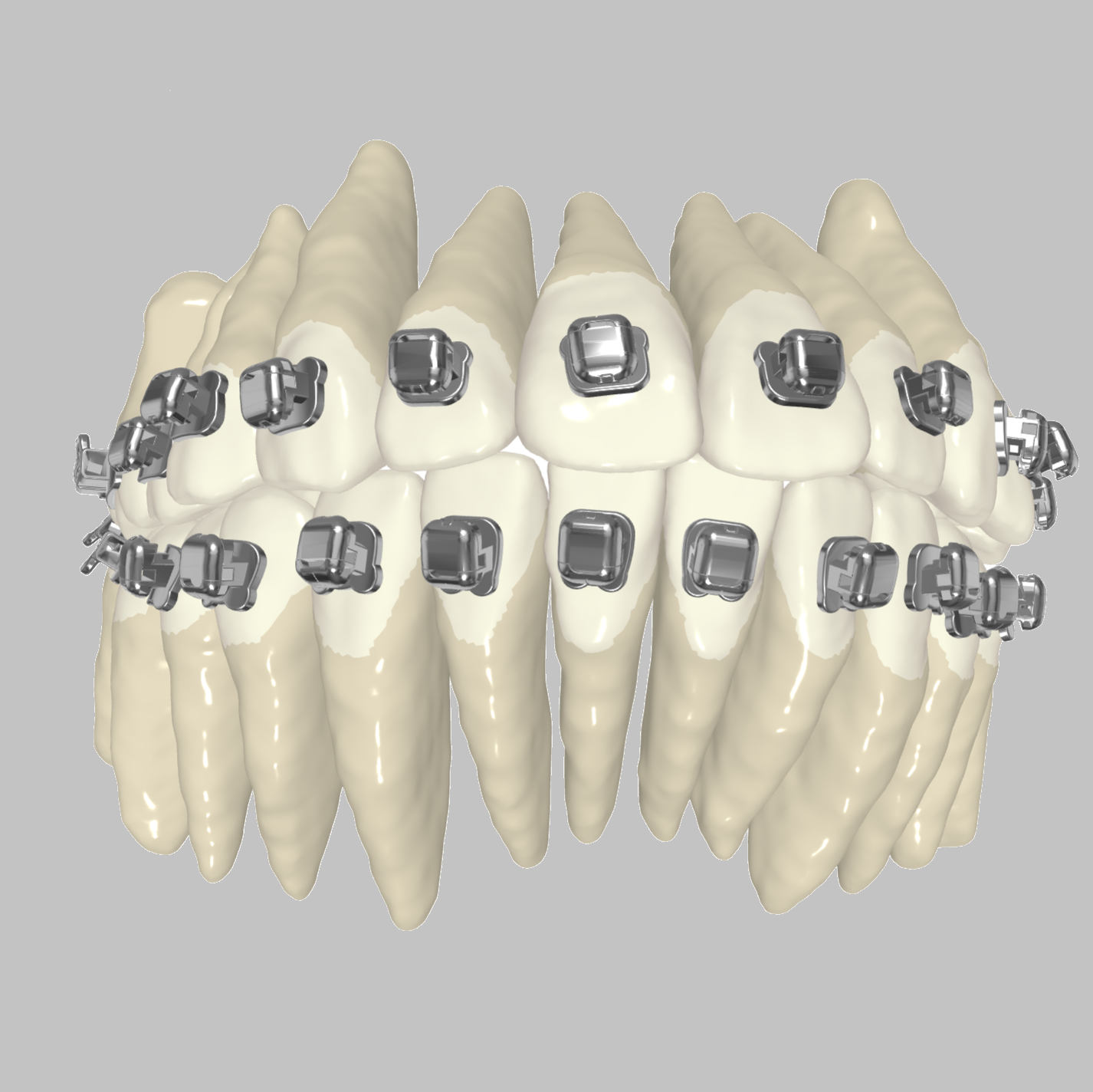 Custom Braces - as easy as clear aligners!